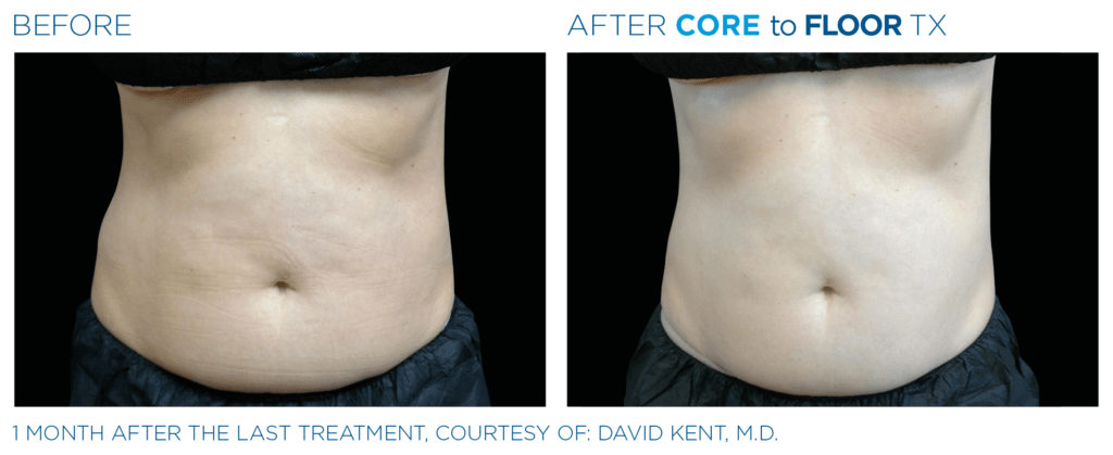 Emsculpt_Neo-Emsella_PIC_Ba-card-female-abdomen-013_ENUS100