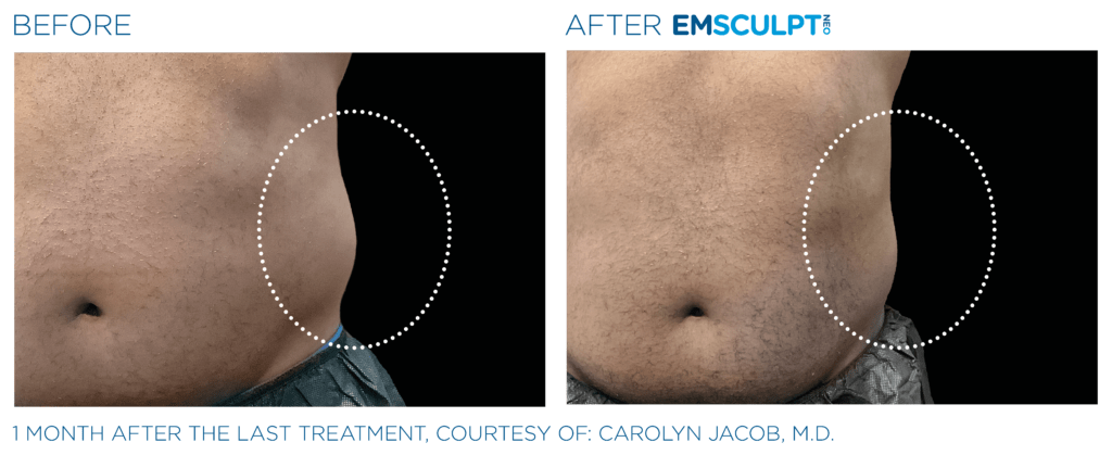 Emsculpt_Neo_PIC_Ba-card-female-lateral-abdomen-158_ENUS100