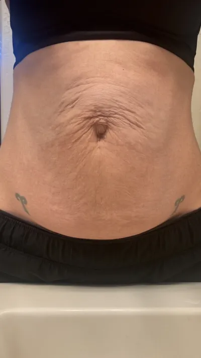 Abdomen with loose skin and wrinkles around the navel, tattoos at each hip, black waistband visible above.