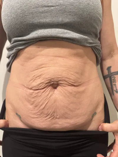 Close-up of a midsection with loose, wrinkled abdominal skin, navel in the center, tattoos at the sides, and a grey top lifted.